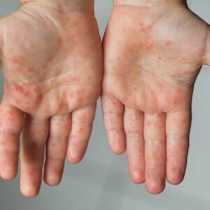 Hand, Foot & Mouth formula